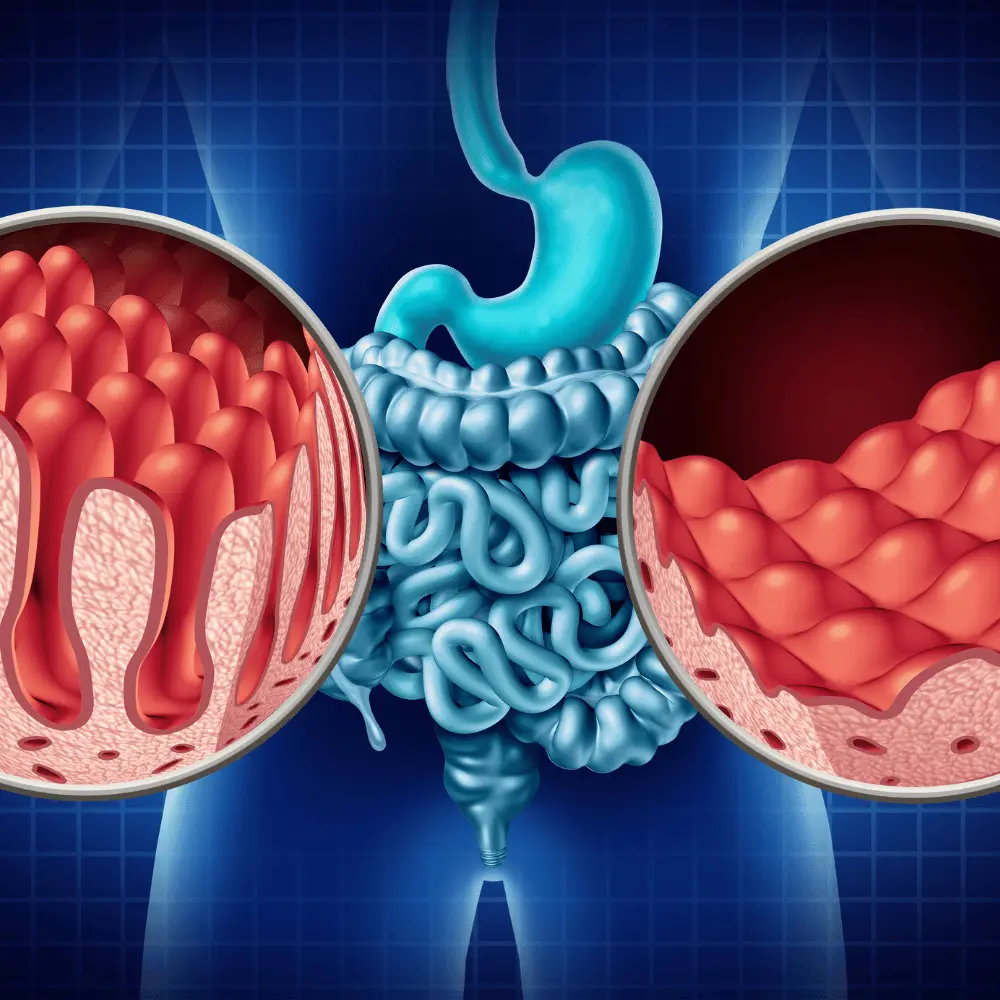 celiac intestine disease with colon and stomach illustration