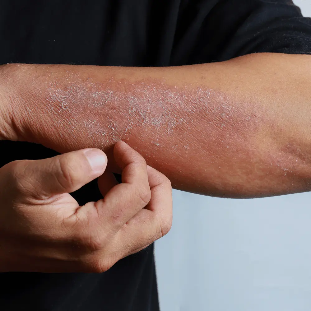 dermatitis herpetiformis skin rash on the arm