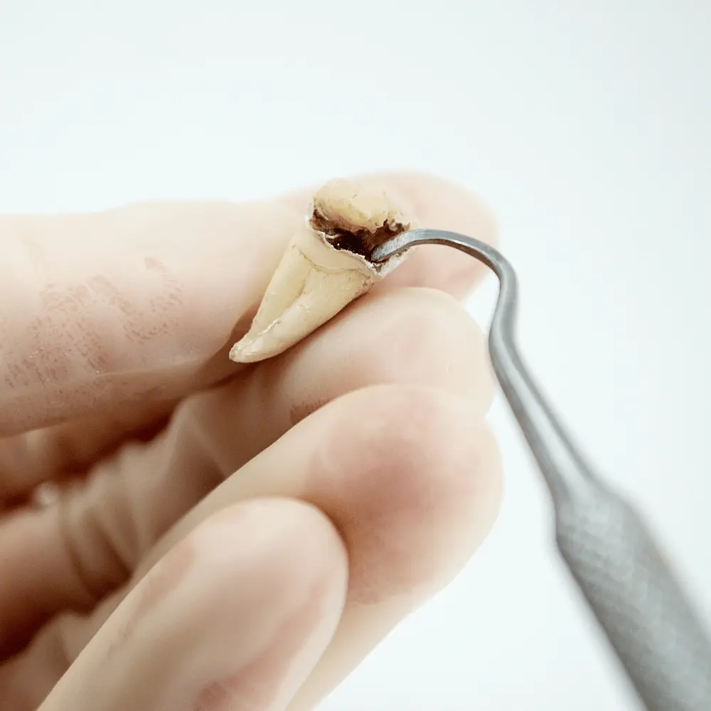 dentist inspecting a decayed tooth from cavities