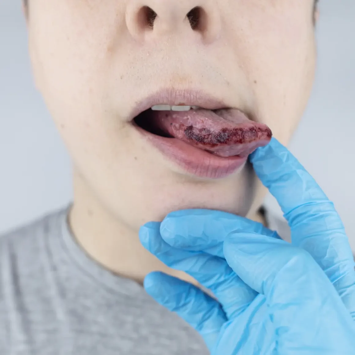 a person showing a his burnt tongue