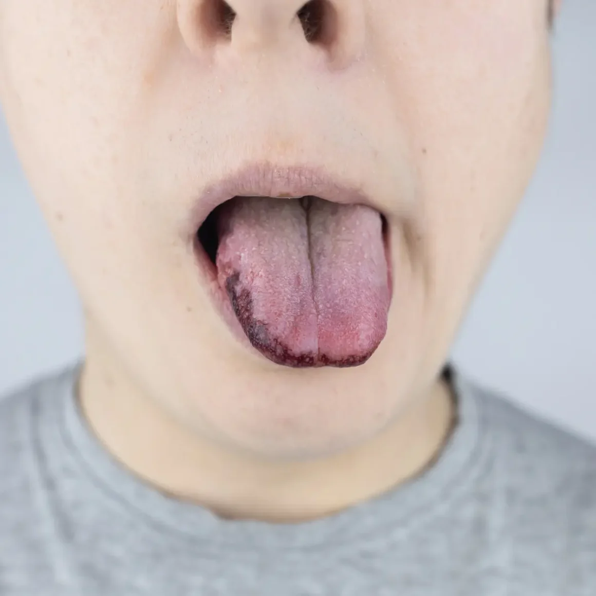 a person showing a his burnt tongue