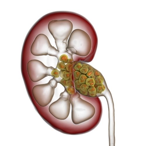 Drinking Coffee Prevents Kidney Stones Drinking Coffee Prevents Kidney Stones