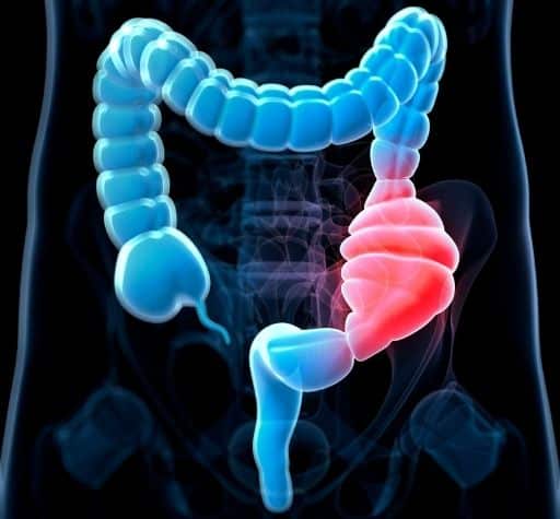 Constipated Colon Constipated Colon